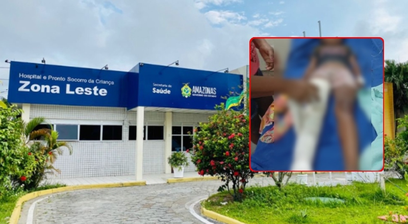 Mais uma vítima no trânsito: Menina de 8 anos é transferida para hospital de Manaus às pressas com fraturas